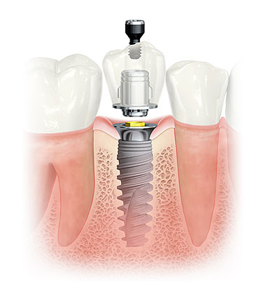 ON1 atrama apsaugo dantenas nuo pažeidimo, o žandikaulio kaulą – nuo tirpimo