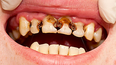 Savęs nuodijimosi malonumui paaukoti dantys, lėšos ir sveikata